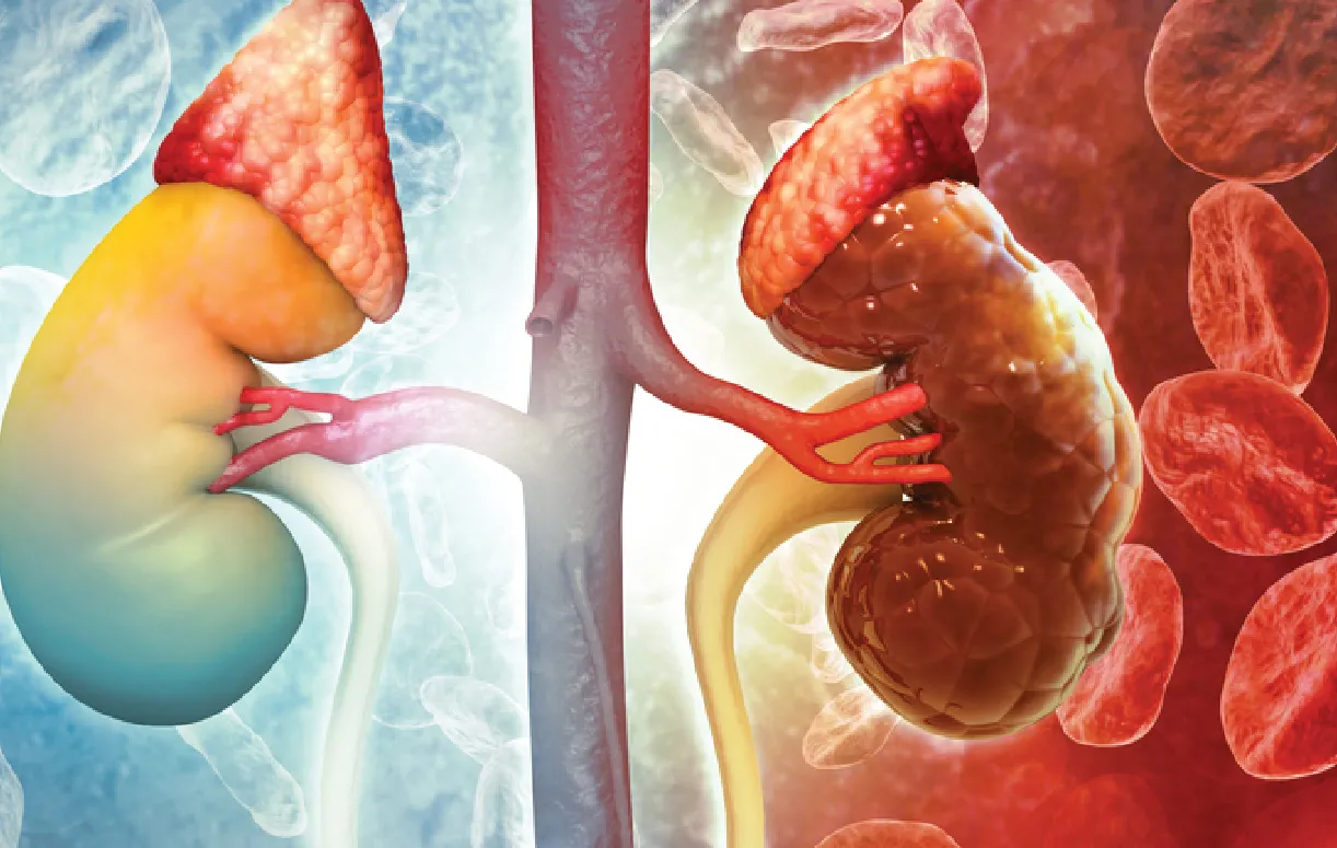 Kidney Failure