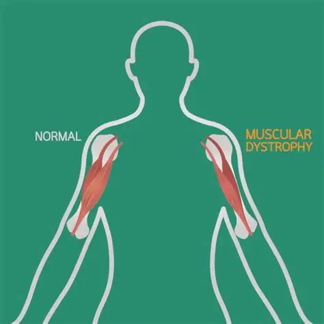 Muscular Dystrophy